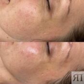 Программа "Революционное омоложение" HydraFacial A21.01.007 фото 4