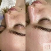 Программа Глубокое очищение лица и шеи (пилинг 7,5%) HydraFacial A21.01.007 фото 4