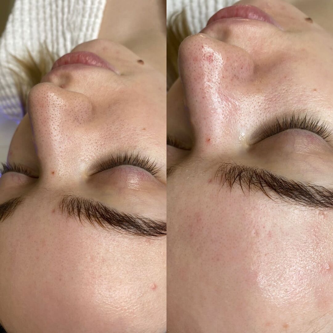 Программа для лица, шеи и декольте HydraFacial A21.01.007 фото 1