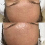 Программа "Революционное омоложение" HydraFacial A21.01.007 фото 1