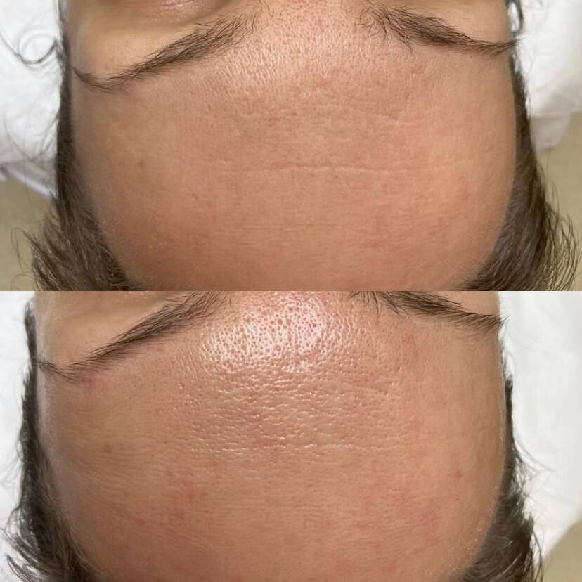 Программа "Революционное омоложение" HydraFacial A21.01.007 фото 1