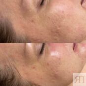 Программа "Революционное омоложение" HydraFacial A21.01.007 фото 2