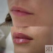 Контурная пластика Belotero Lips Shape 0,6 мл A11.01.013 фото 3