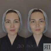 Безинъекционная мезотерапия для лица Dermadrop TDA "Лечебный комплекс" A21.01.007 фото 2